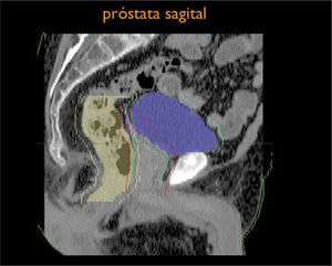 Volúmenes para planificación de próstata, corte sagital