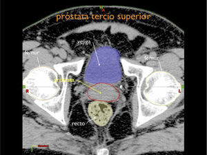 Volúmenes para planificación de próstata, corte axial de tercio superior