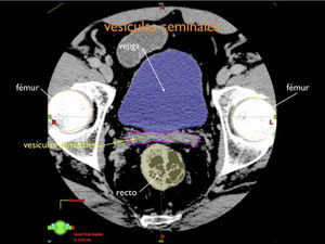 Volúmenes para planificación de próstata corte axial a nivel de vesículas seminales