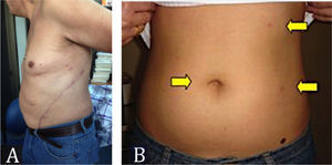 Comparación de incisiones A) Toraco-Lumbotomía Izquierda para Nefrectomía Radical Abierta. B) Puertos para Nefrectomía Laparoscópica. (Con la debida autorización de los pacientes).