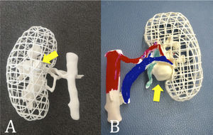 Uso de modelos impresos en 3D para planificar el abordaje laparoscópico o robótico de la nefrectomía parcial compleja A)Tumor Intrarrenal completo B) Tumor del Hilio Renal