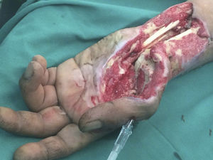 Necrosectomía muscular con exposición de 1ª articulación metacarpofalángica izquierda La 1ª articulación metacarpolángica izquierda requiere fijación con aguja de bránula 14 French.
