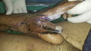 Reparación y cobertura de eminencia tenar izquierda con colgajo inguinal de McGregor izquierdo