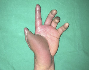 Un año evolución post accidente, se realizó remodelación de colgajo logrando abrir primer espacio interdigital y rebajar eminencia tenar A los 7 meses post colgajo inguinal mano izquierda presenta flexión permanente de 4° y 5° dedo, según evaluación traumatológica por atrapamiento tendinoso; eminencia tenar prominente.