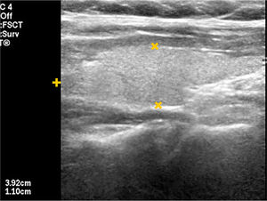 Tiroides normal. Lóbulo tiroideo en corte longitudinal, parénquima homogéneo, de ecogenicidad normal, de forma y tamaño normal.