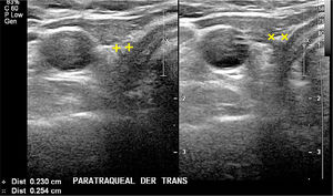 Lecho post operatorio. Cortes transversal cervical paratraqueal derecho, a dos niveles diferentes en el mismo paciente tiroidectomizado. No hay imagen de tejido tiroideo. Dos pequeñas estructuras hiperecogénicas, con sombra acústica posterior, con caracteres de nódulo calcificado, adyacentes a la tráquea.