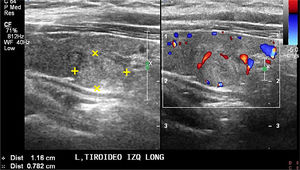 Tiroiditis crónica: Pseudonódulo. Corte longitudinal de un lóbulo tiroideo con un pseudonódulo. La foto izquierda en modo B y la foto derecha, doppler color del mismo sector.