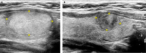 Ablación de nódulo tiroideo benigno con radiofrecuencia. A: Nódulo sólido, de 27.2mm de eje longitudinal (2.58 cc), levemente hiperecogénico, con dos PAAF negativas para células neoplásicas. Control pre ablación con radiofrecuencia (RF). B: Control ecográfico a los 6 meses post ablación con RF del nódulo de la figura 17a El volumen del nódulo (0.51cc) disminuyó un 80%.