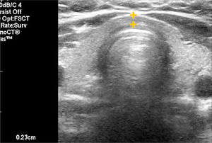 Tiroides normal. Tiroides en un corte transverso. El istmo de grosor normal, mide 2.3mm de diámetro anteroposterior.