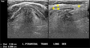 Tiroides normal. Foto izquierda: corte transversal: el lóbulo piramidal en ubicación paramediana derecha (punta de flecha). Foto derecha: corte longitudinal: el lóbulo piramidal pre-laríngeo izquierdo se continúa imperceptiblemente con el istmo (c: craneal; i:istmo).