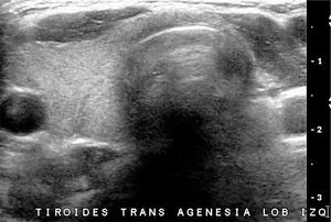 Hemiagenesia tiroidea. Hemiagenesia del lóbulo tiroideo izquierdo: Paciente sin antecedente quirúrgico. No hay parénquima glandular paratraqueal izquierdo. En este caso el istmo está presente.