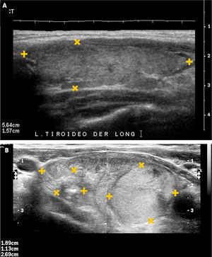 Bocio. A: Tiroides en un corte longitudinal, de forma globulosa aumentado de tamaño, contornos suavemente lobulados, parénquima hipoecogénico, heterogéneo, sin imágenes de nódulos en su espesor. B: Tiroides en un corte longitudinal, globuloso aumentado de tamaño, contornos lobulados, hipoecogénico, heterogéneo, con nódulos sólidos de diferente tamaño.