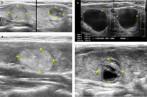 Nódulos tiroideos. A: A la izquierda un nódulo tiroideo sólido, isoecogénico (igual ecogenicidad que el resto del lóbulo) y a la derecha la imagen de un nódulo hipoecogénico (más oscuro que el resto del tejido tiroideo normal circundante), en este caso con algunas calcificaciones gruesas (imágenes blancas de ubicación excéntrica, superiores derechas). B: Corte ecográfico longitudinal de un nódulo tiroideo (entre las cruces): sólido, hiperecogénico, bien delimitado, sin calcificaciones. C: Nódulo tiroideo quístico (anecogénico): el ultrasonido traspasa la estructura líquida sin generar ecos e inmediatamente dorsal al quiste hay un refuerzo del ultrasonido, por mayor disponibilidad de energía para emitir más ecos. D: Nódulo tiroideo sólido quístico (o mixto), rodeado por un halo hipoecogénico. La porción periférica del nódulo es sólida, isoecogénica y el centro es líquido (anecogénico).