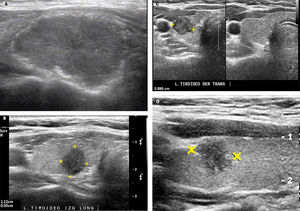 Nódulos tiroideos con caracteres ecográficos de malignidad. A: Nódulo tiroideo sólido, marcadamente hipoecogénico, además presenta microcalcificaciones en la periferia (Ca papilar). B: Nódulo tiroideo sólido más alto que ancho: diámetro anteroposterior (alto) mayor que el diámetro longitudinal (ancho). (Ca papilar). C: Nódulo tiroideo sólido, en un corte transversal, adyacente a la arteria carótida común, de contornos microlobulados, hipoecogénico y heterogéneo. (Ca papilar). D: Nódulo tiroideo sólido, con microcalcificaciones en el interior y periferia. (Ca papilar).
