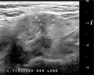 Nódulo sólido. Nódulo sólido con microcalcificaciones y calcificaciones periféricas; el tumor rebasa los límites de las calcificaciones periféricas.