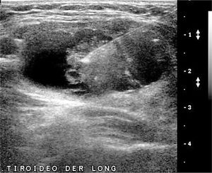 PAAF bajo visión ecográfica. Punción aspirativa con aguja fina bajo visión ecográfica. Nódulo sólido quístico, mayor de 20mm de diámetro, con microcalcificaciones en el componente sólido. La aguja en la zona sólida del nódulo.