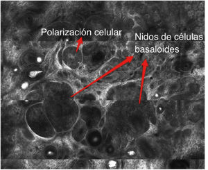 Foto de mosaico de MCR evidenciando la presencia de hallazgos altamente sugerentes de carcinoma basocelular