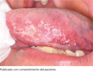Carcinoma de cavidad oral en borde izquierdo de lengua en relación con leucoplasia (mancha blanquecina).