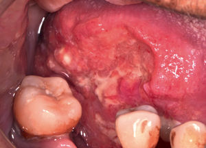 desplazamiento lateral de lengua, borde de lengua con carcinoma de cavidad oral de crecimiento endofítico