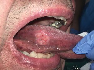 Carcinoma de cavidad oral en borde de lengua