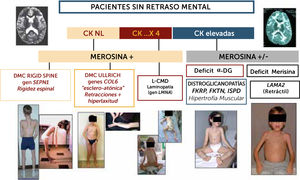 Algoritmo diagnóstico de las formas de DMC sin retraso cognitivo significativo La orientación diagnóstica de las DMC en el niño sin retraso cognitivo puede ser guiada por datos biológicos (CK), expresión inmuno-histoquímica (merosina, alfa-DG). Los marcadores clínicos son particularmente útiles para sospechar las diferentes formas: en las formas con CK poco elevadas o normales, si el paciente presenta una rigidez selectiva de la columna deberá estudiarse el gen SEPN1 en prioridad (rigid spine sindrome); si existe una hiperlaxitud distal junto con una rigidez axial y retracciones articulares proximales (hombros, codos, caderas rodillas) se sospechara primeramente una DMC de tipo Ullrich y los genes a estudiar serán COL6A1, COL6A2 y COL6A3). Si el paciente no tiene progresos motores o pierde el sostén cefálico se sospechará una Laminopatía (gen LMNA); En casos de CKs elevadas hay dos posibilidades fundamentalmente: si el fenotipo es retráctil, con músculos más bien atróficos, inteligente pero con anomalías difusas en RM de substancia blanca cerebral, el diagnóstico más probable será de DMC con déficit de merosina. Si el fenotipo es hipertrófico, una distroglicanopatía por uno de los tres genes del subgrupo de déficit de fosfato-inositol deberán ser estudiados (FKRP, FKTN, ISPD).