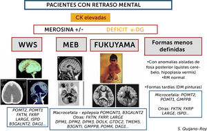 Algoritmo de las DMCs con retraso mental (distroglicanopatías) Este grupo de DMC presenta incremento importante de CKs de forma constante (salvo si estado muy avanzado de la enfermedad con atrofia muscular severa) y pueden presentar varios tipos de síndromes: Walker-Warburg (WWS), con lisencefalia de tipo empedrado (cobblestone) y anomalías muy severas malformativas de cerebro fosa posterior y tronco cerebral, incompatibles con la vida o con pronóstico de supervivencia limitado. Muscle-Eye-Brain (MEB) que presenta anomalías menos severas múltiples (malformaciones en cerebro, cerebelo y tronco, anomalías de substancia blanca) con frecuencia asociadas a afectación ocular. Esta forma en Japón se debe fundamentalmente a un gen (FKTN o fukutina, y conduce a la DMC de tipo Fukuyama). Se pueden encontrar, además, casos con RM normal y con anomalías mínimas (microcefalia) o aisladas de fosa posterior, o vermis cerebeloso, que no son conocidas por términos específicos. Hay actualmente al menos 18 genes, existiendo una heterogeneidad genética de los diferentes síndromes.