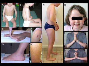 Características clínicas de pacientes con DMC de Ullrich A-B) Niño con forma precoz severa (sin adquisición de la marcha). Hay una cifosis dorsal rigida y retracciones en codos y miembros inferiores. C) Forma moderada-severa (con adquisición de la marcha pero con agravación progresiva en la infancia), que muestra signos similares pero menos marcados. D-J) Diferentes marcadores fenotípicos caracteristicos de esta forma, incluyendo facies redondeada y cuello fino (D), hiperlaxitud distal de dedos (E), hipertrofia de cicatrices (F), protrusión de calcáneos (G), piel rugosa o granulosa (H), y retracciones de las articulaciones de los dedos detectadas cuando se pide al paciente que coloque sus manos en postura de “plegaria” con extensión máxima de las muñecas (J comparado a I). (Quijano-Roy et al. Congenital Muscular Distrophies, Neuromuscular Imaging - Wattjes & Fischer, Springer, 1st Ed, 2013: 189)