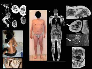 Aspecto clínico y RM muscular en pacientes con miopatías relacionadas con COL6: DMC Ullrich moderada progresiva (A-E) Forma intermediaria Ullrich/Bethlem (F-K) A-C: RM muscular de cuerpo entero (T1-TSE) en una niña de 12 años con UCMD, que perdió la marcha a los 10 años de edad. A) Debido a las retracciones articulares severas de caderas y rodillas, un protocolo y posicionamiento especial deben realizarse en el examen de RM con el fin de obtener imágenes con cortes de muslos y piernas perpendiculares al eje mayor de las extremidades. A notar el patrón típico de RM muscular de la miopatía COL6 en miembros inferiores. B) RM a nivel del muslo que muestra las bandas típicas en bizcocho enrollado a nivel del músculo vasto lateral (flecha gruesa negra) y en el recto anterior que presenta una muesca vertical (flechas finas). C) La pierna muestra el borde ribeteado híper-intenso entre el músculo soleo y los gastrocnemios (estrellas negras). D,E) Aspecto clínico del paciente con retracciones de codos y cicatriz hipertrofiada (D), e hiperlaxitud llamativa de los dedos(E). F-K: Características clínicas y patrón radiológico de un paciente de 21 años con una forma intermediaria (Ullrich/Bethlem). F) Inicio de síntomas en la infancia con retraso de marcha e hiperlaxitud, evolución lentamente progresiva con desarrollo de retracciones de codos y tobillos durante la infancia. H-K) La RM muscular de cuerpo entero muestra el aspecto típico en bandas (tigroide), en el que se alternan bandas de híper e hipo intensidad (flechas) en diferentes músculos de diferentes regiones: H) Hombros: bandas radiales en el músculo deltoides (Del), perpendiculares en el músculo subescapular (SC) y supra espinoso (SS). I-J) Imagen de RM del brazo, en secuencia T1-TSE (I) y STIR (J): banda horizontal en el músculo tríceps braquial (TRI). K) Signos de infiltración fibro-adiposa severa y bandas verticales en los músculos paravertebrales lumbares (PV). (Quijano-Roy et al. Congenital Muscular Distrophies, Neuromuscular Imaging - Wattjes & Fischer, Springer, 1st Ed, 2013: 190).