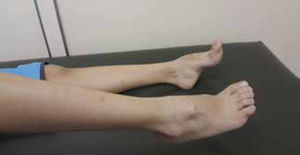 Legs and feet in a patient with CMT Note the atrophy of the distal portions of the legs and deformities in the feet (cavus feet, hammer toe).
