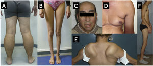 Hallazgos característicos de algunas formas comunes de distrofia muscular del adulto A. Distrofinopatía, distrofia de Becker (BMD). Vista posterior de las extremidades inferiores de un paciente con BMD. Se observa una marcada pseudohipertrofia de pantorrillas. B. Disferlinopatía, Miopatía de Miyoshi/LGMD2B. Se observa una severa atrofia de las pantorrillas. C. Facies Miotónica en un paciente con Distrofia Miotónica Tipo 1 (DM1, Enfermedad de Steinert). El paciente muestra calvicie, atrofia de músculos temporales, ptosis palpebral bilateral y paresia facial. Este paciente presentaba además un síndrome de cabeza caída por paresia extensora del cuello. D. Atrofia de la musculatura escapular en un caso de distrofia facio-escápulo-humeral (FSHD). Se observa el signo del pliegue axilar, abultamiento abdominal, y la atrofia del brazo. E. Despegamiento escapular en un caso de FSHD. F. Síndrome de Emery-Dreifuss en un caso de laminopatía. En el contexto de una amiotrofia generalizada, paciente presenta retracciones de codos, cuello y columna, la retracción Aquiliana está corregida por una intervención quirúrgica (tenotomía). Fotos autorizadas para publicación.