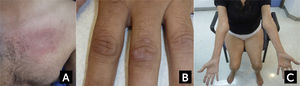 Características clínicas en dermatomiositis y Miositis por Cuerpos de Inclusión (A) Rash eritematoso en la base del cuello y región pectoral en un caso de dermatomiositis. (B) Pápulas de Gottron en dermatomiositis. (C) Atrofia de los flexores largos de los dedos a nivel del antebrazo y de cuádriceps en un caso de miositis por cuerpos de inclusión esporádica. Fotos autorizadas por padres y/o pacientes.
