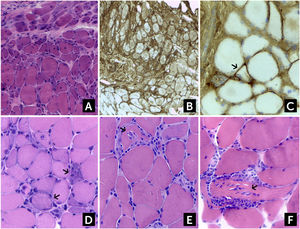 Hallazgos histológicos en Dermatomiositis (DM), Miopatía Necrotizante Inmuno-Mediada (IMNM) y Miositis por Cuerpos de Inclusión (sIBM) (A) Atrofia perifascicular en DM. En el mismo paciente, (B) la biopsia muestra un aumento difuso de la expresión del complejo mayor de histocompatibilidad I (HLA-I), y (C). hay un aumento de depósitos de complemento C5b-9 a nivel de fibras aisladas (flechas), que son característicos de DM. (D) En la IMNM se observan fibras necróticas aisladas, sufriendo miofagocitosis (flechas). Los infiltrados inflamatorios están ausentes o son muy escasos. (E, F) sIBM, los infiltrados inflamatorios intersticiales invaden fibras de aspecto conservado, que a veces producen el efecto de “tunelización” (flechas). (A, D, E y F) hematoxilina-eosina; (B y C) Reacción Inmunohistoquímica para HLA-I y C5b-9 respectivamente.