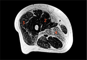 Paciente con miopatía nemalínica Imagen axial T1 del muslo proximal. Estimación de infiltración grasa de acuerdo a escala de Goutallier. Estrías grasas considerables en vasto medial, intermedio y recto femoral del cuádriceps (grado 2), tanto grasa como músculo en vasto lateral (3) y más grasa que músculo en aductor mayor (4).