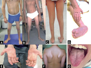 Manifestaciones clínicas de enfermedades con compromiso de segunda motoneurona (A y B) Distribución habitual de atrofias musculares espinales distales con predominio de amiotrofia y debilidad en extremidades inferiores. (C) Pie equino y amiotrofia distal bajo la rodilla. (D) Lactante con contracturas y deformidad de manos y pies. (E) Amiotrofia musculatura intrínseca de la mano, eminencia tenar e hipotenar. (F) Escapula alada. (G) Atrofia y fasciculaciones linguales. Fotos autorizadas por padres y pacientes.