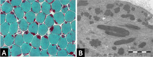 ] Nemaline myopathy with mutations in NEB gene; (A) Clusters of rods at the periphery of fibers staining red at GT. (B) Electron micrograph showing nemaline bodies transversally and longitudinally oriented.