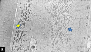 ] Core-rod myopathy. Electron micrographs showing a fiber harboring both rods (indicated by a yellow star) and a core lesion (indicated by a blue arrow).