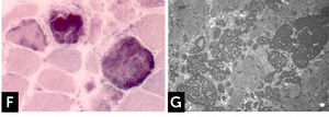 ] Reducing body myopathy (RBM) due to FHL1 mutations. (F) RBs stain blue strongly reducing NBT with menadione reaction without α-glycerophosphate. (G) Electron microscopy. RB material corresponds to coarse tubulofilaments.