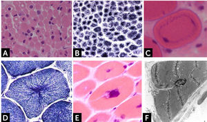 (A) H&E staining of frozen muscle section from a patient presenting myotubular myopathy (MTM1). Presence of rounded muscle fibers with centrally located nuclei, resembling myotubes. (B) NADH reaction showing clear peripheral halo. (C) Necklace fiber in a biopsy from a female MTM1 symptomatic carrier. (D) Particular radiated disposition of the sarcoplasmic reticulum as the “spokes of a wheel” in a DNM2 mutated patient muscle. (E) Cluster of myonuclei and membrane invagination in a muscle biopsy from a patient with AR BIN1 mutations. (F) Electron microscopy shows a centralized nucleus with membrane invagination.