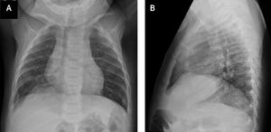 Rx de tórax normal efectuada a los 5 meses de edad (a) proyección frontal (b) lateral.