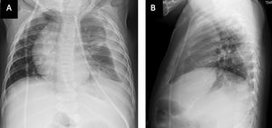 Rx de tórax demuestra desviación de mediastino a derecha, con extremo de catéter derivativo en vértice de hemitórax izquierdo y líquido pleural (a) proyección frontal (b) lateral.