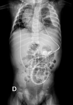 Rx tóracoabdominal evidencia curso de catéter derivativo en pared de hemitórax derecho, que desciende al abdomen y luego asciende al hemitórax izquierdo.