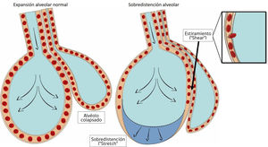 Formas de daño a nivel alveolar. A la izquierda de la figura se aprecia un alvéolo normalmente expandido junto a un alvéolo colapsado a su derecha. Tanto un exceso de volumen corriente (volutrauma) como exceso de presión (altos niveles de PEEP) pueden generar sobredistención o “stretch”, nótese en la figura el colapso a nivel capilar, que provoca redistribución del flujo sanguíneo en la figura de la derecha. El mecanismo de atelectrauma se basa en el estiramiento o “shear” anormal y repetitivo de los alvéolos colapsados, mediante fuerzas que actúan de forma tangencial, en este caso el alvéolo que se distiende más allá de su capacidad normal, debido a que comparte parte del citoesqueleto con el alvéolo colapsado adyacente, genera fuerzas de cizallamiento. Esta fuerza afecta principalmente a las células del endotelio, provocando incluso ruptura de éste.