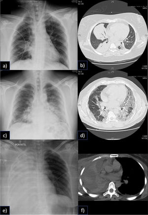 Heterogeneidad del Síndrome de distrés Respiratorio Agudo y la falla respiratoria catastrófica En la figura, a) se aprecia una condensación en el lóbulo inferior derecho del paciente, sin embargo, en b) la tomografía computada muestra tres condensaciones, rodeadas de parénquima pulmonar normal. En un paciente que no tenía potencial de reclutamiento y que, por lo tanto, altos niveles de PEEP provocaban sobredistención. Fue manejado con volúmenes corrientes y PEEP bajos, además de ECCO2R. En c) se aprecia una condensación en lóbulo inferior y superior izquierdos, así como también en base derecha. En la tomografía computada (d), se aprecia que el componente no es tan denso como en b, este paciente mostró buena respuesta al reclutamiento y a la ventilación en posición prono. Ambos pacientes desarrollaron una falla respiratoria catastrófica, sin embargo, las aproximaciones terapéuticas fueron notablemente distintas. En el tercer caso en e) podemos apreciar una atelectasia completa de todo el pulmón derecho (f), que también llevó al paciente a falla respiratoria catastrófica, sin ser un SDRA.