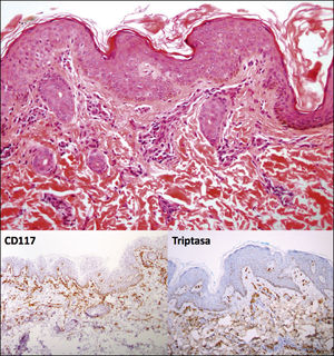 Biopsia cutánea con tinción de hematoxilina-eosina (H-E) e inmunohistoquímica.