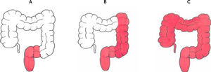 Dibujo esquemático de los tipos de compromiso colónico en colitis ulcerosa A: Proctitis. B: Colitis izquierda. C: Colitis extensa o pancolitis.