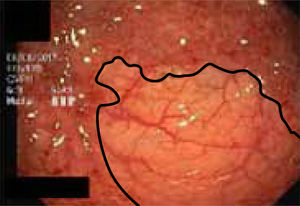 Imagen endoscópica de colon que muestra la clara zona limitante entre mucosa sana y mucosa enferma en colitis ulcerosa.