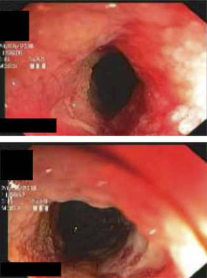 Imagen endoscópica de mucosa ileal inflamada, ulcerada, cubierta por fibrina y con lumen estenótico, en enfermedad de Crohn.