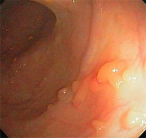 Imagen endoscópica de colon con múltiples pólipos inflamatorios en colitis ulcerosa.