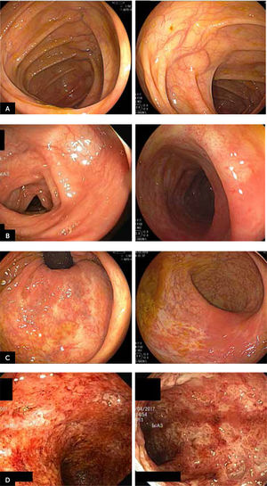 Imágenes endoscópicas de colon con diferentes grados de compromiso mucoso clasificados según subscore endoscópico de Mayo A:MAYO 0. Enfermedad inactiva Colon normal. B:MAYO 1. Enfermedad leve Mucosa con leve eritema. Ausencia patrón vascular. submucoso. Leve friabilidad. C:MAYO 2. Enfermedad moderada Mucosa eritematosa. Ausencia patrón vascular. Erosiones y friabilidad marcada. D:MAYO 3. Enfermedad severa Mucosa ulcerada. Sangrado espontaneo.