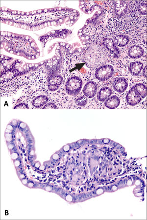 Granulomas en Enfermedad de Crohn.